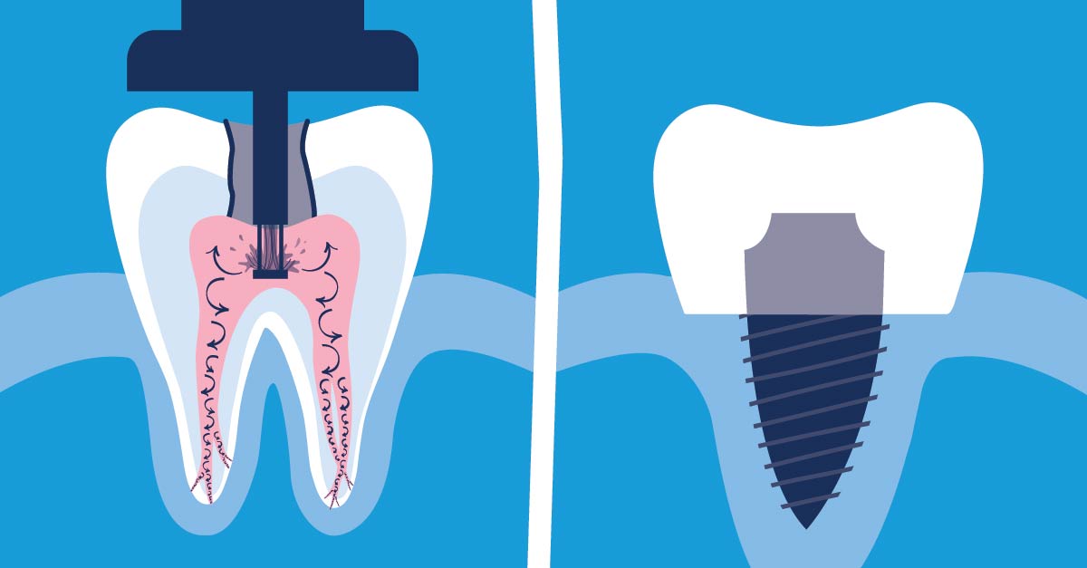Root Canal Procedure or Dental Implant Procedure?